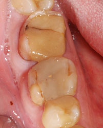 Трещины на зубах – причины, профилактика, диагностика и лечение